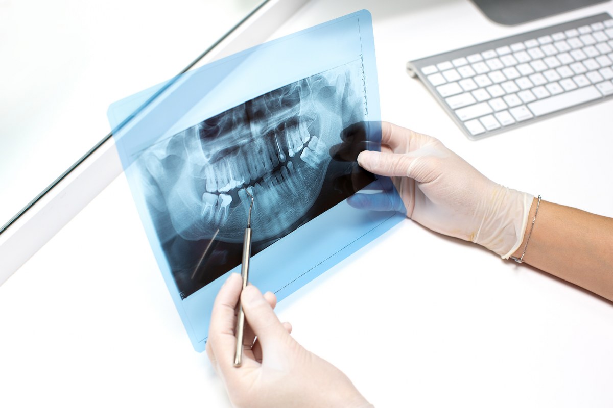 Da li je vađenje živca siguran način da prestane da Vas boli zub?