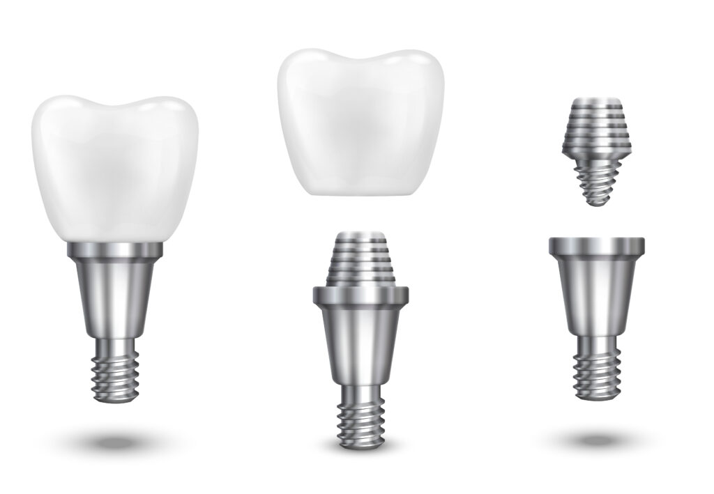 zubni implanti kruna dental Prefabrikacija privremene proteze pre hirurgiji