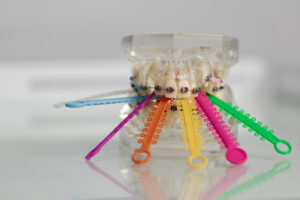Slika za članak plastične navlake za zube